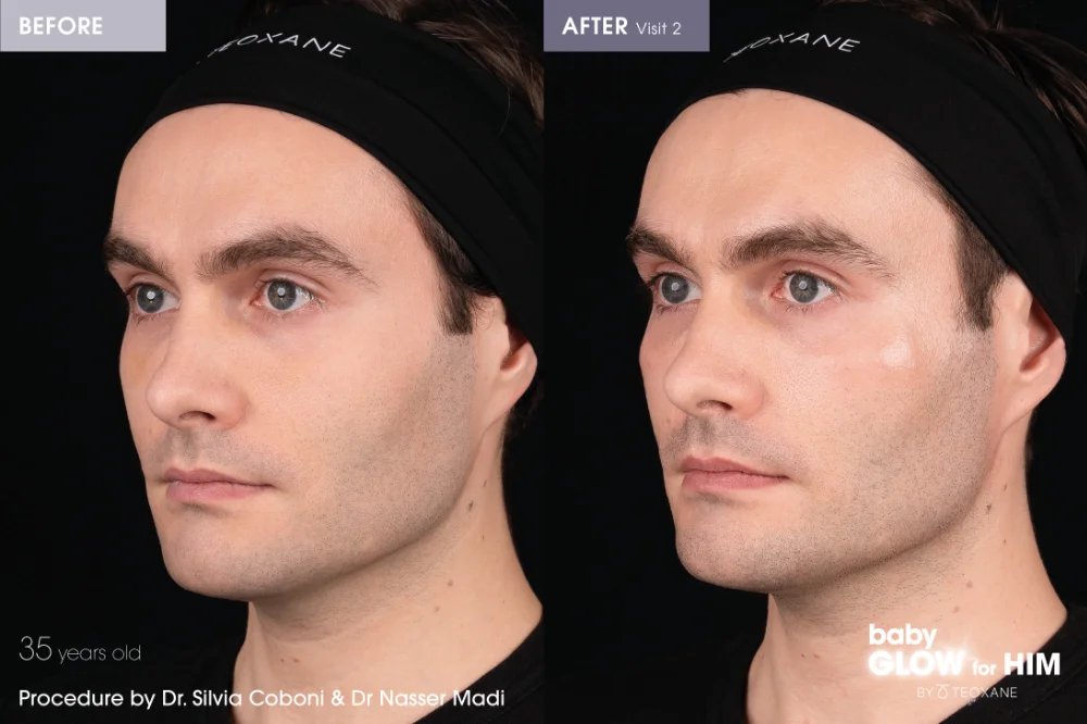 Teoxane Redensity before and after
