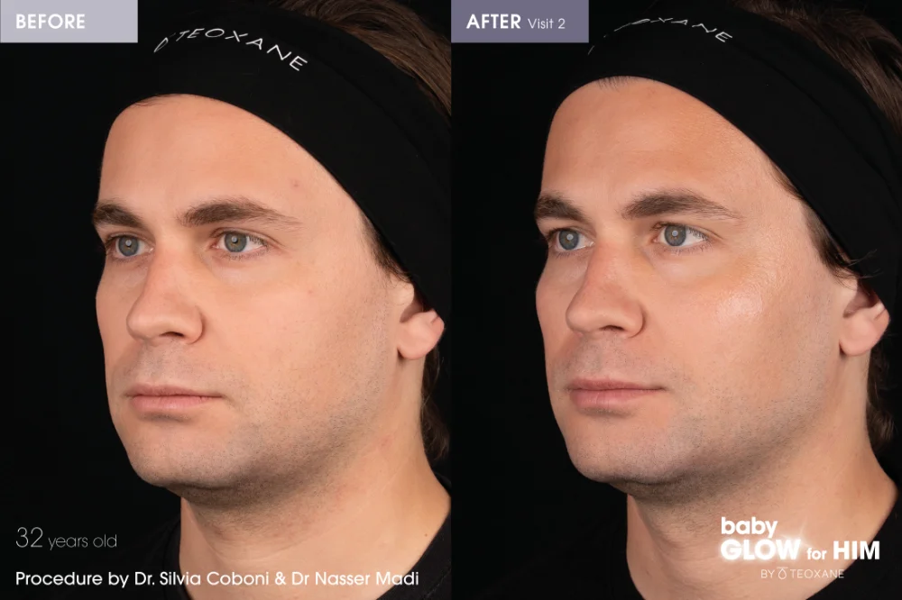 Teoxane Redensity before and after
