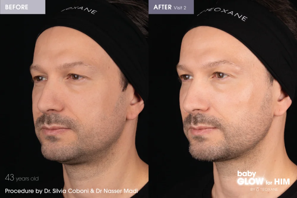Teoxane Redensity before and after